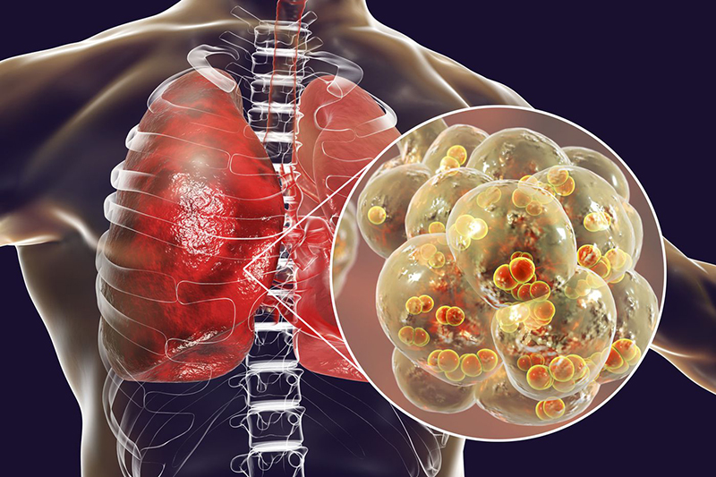 Viêm phổi (nhiễm trùng nhu mô phổi) là một trong những biến chứng thường gặp nhất của bệnh ho gà.